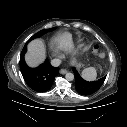 Cecal adenocarcinoma (Radiopaedia 64871-73817 A 6).jpg
