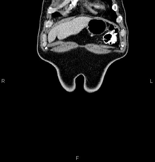 Cecal adenocarcinoma (Radiopaedia 85324-100916 D 2).jpg