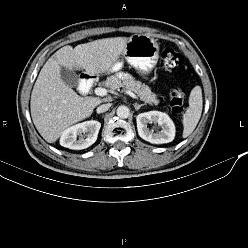 Cecal cancer with appendiceal mucocele (Radiopaedia 91080-108651 B 35).jpg