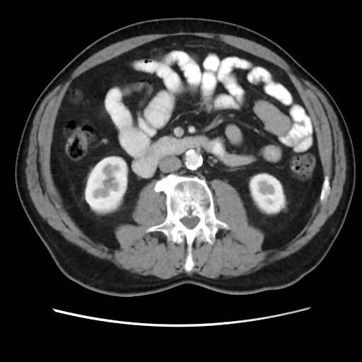 Cecal mass causing appendicitis (Radiopaedia 59207-66531 A 43).jpg