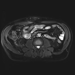 File:Cecal mass causing appendicitis (Radiopaedia 59207-66532 Axial T2 fat sat 30).jpg