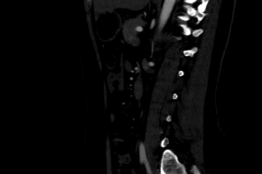 File:Celiac artery compression syndrome (Radiopaedia 47538-52152 B 63).jpg