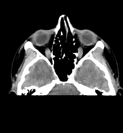 File:Cemento-ossifying fibroma (Radiopaedia 46243-50643 Axial C+ delayed 18).png