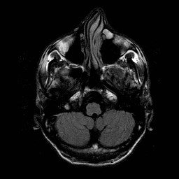 File:Central-variant posterior reversible encephalopathy syndrome (PRES) (Radiopaedia 43880-47359 Axial FLAIR 3).jpg