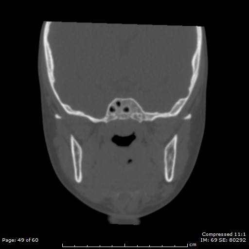 Central giant cell granuloma (Radiopaedia 45612-49754 Coronal bone window 49).jpg