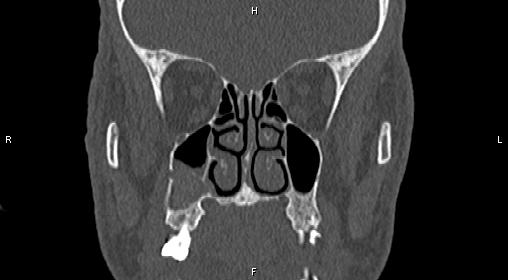 File:Central giant cell granuloma (Radiopaedia 83346-97761 Coronal bone window 15).jpg
