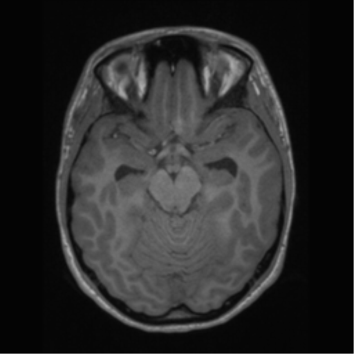 File:Central neurocytoma (Radiopaedia 37664-39557 Axial T1 27).png