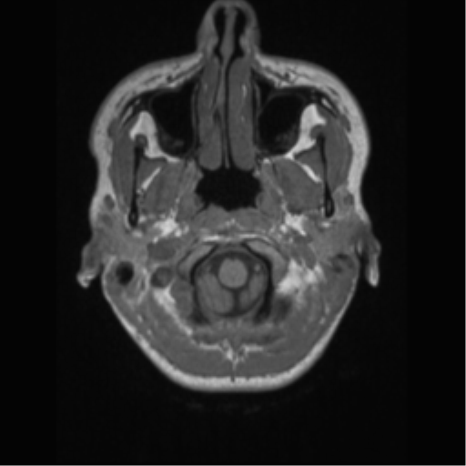 File:Central neurocytoma (Radiopaedia 37664-39557 Axial T1 5).png