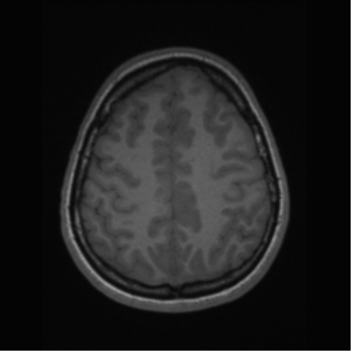 File:Central neurocytoma (Radiopaedia 37664-39557 Axial T1 58).png