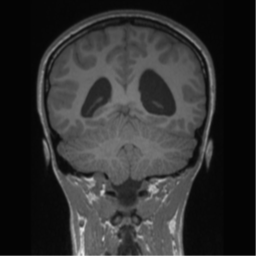 Central neurocytoma (Radiopaedia 37664-39557 Coronal T1 30).png