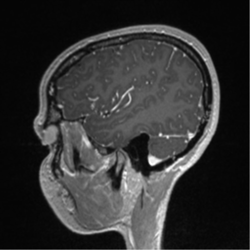 Central neurocytoma (Radiopaedia 37664-39557 Sagittal T1 C+ 76).png