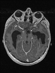 Central neurocytoma (Radiopaedia 56690-63469 Axial T1 C+ 60).jpg