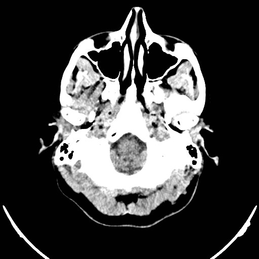 Central neurocytoma (Radiopaedia 84497-99871 Axial non-contrast 2).jpg