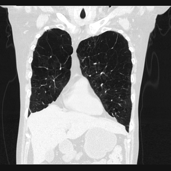 Centrilobular pulmonary emphysema (Radiopaedia 24495-24789 Coronal lung window 18).jpg