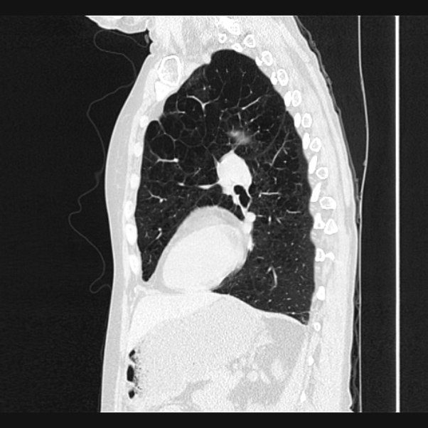 Centrilobular pulmonary emphysema (Radiopaedia 24495-24789 Sagittal lung window 52).jpg