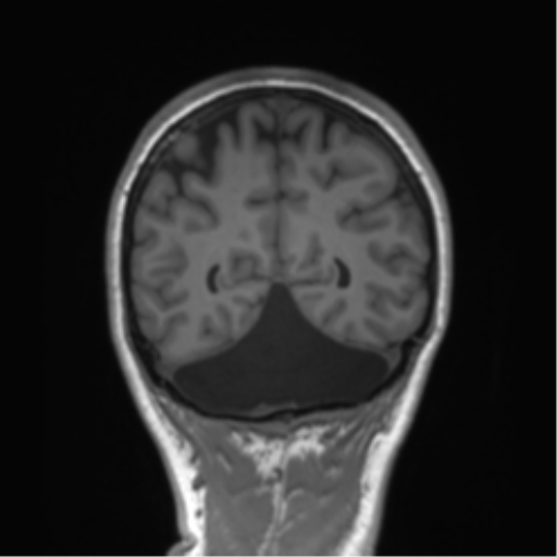 Cerebellar agenesis with hypoplastic pons (pontocerebellar hypoplasia) (Radiopaedia 57224-64138 Coronal T1 26).png