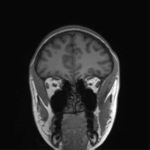 Cerebellar agenesis with hypoplastic pons (pontocerebellar hypoplasia) (Radiopaedia 57224-64138 Coronal T1 72).png