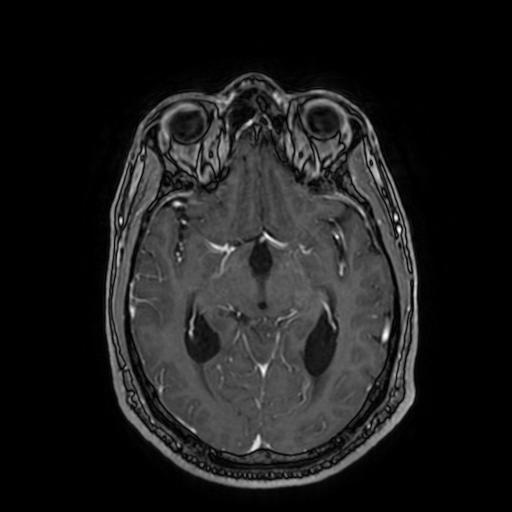 Cerebellar hemangioblastoma (Radiopaedia 88055-104622 Axial T1 C+ 86).jpg