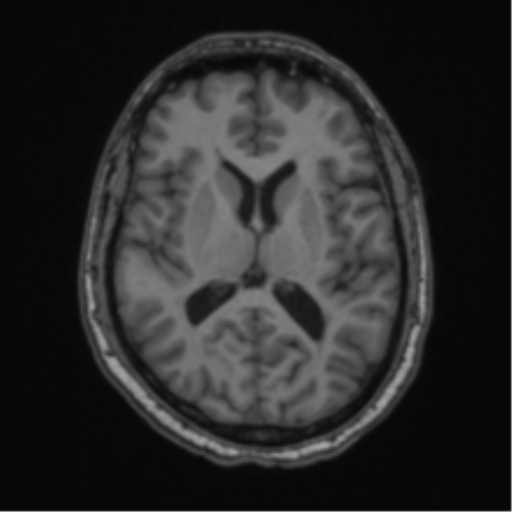 Cerebellar hemangioblastomas and pituitary adenoma (Radiopaedia 85490-101176 Axial T1 41).png