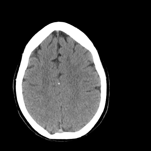 File:Cerebellar infarct due to vertebral artery dissection with posterior fossa decompression (Radiopaedia 82779-97029 Axial non-contrast 21).png