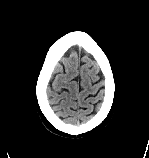 File:Cerebellar infarct due to vertebral artery dissection with posterior fossa decompression (Radiopaedia 82779-97031 Axial non-contrast 28).png