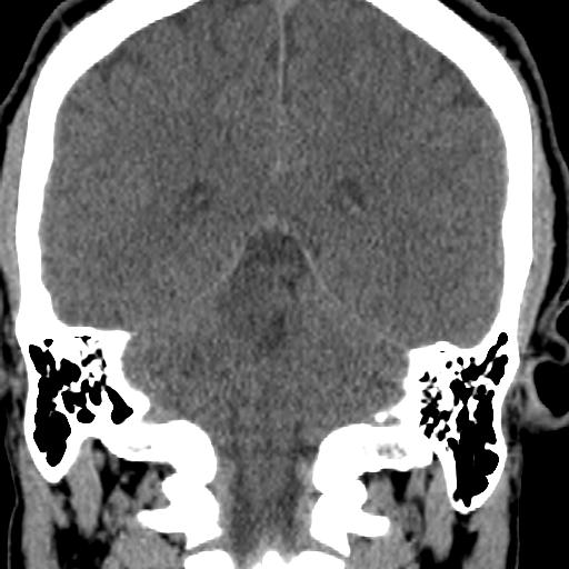 File:Cerebellar infarction (Radiopaedia 16625-16327 Coronal non-contrast 21).jpg
