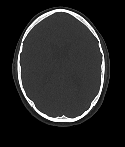 Cerebellar metastases - colorectal adenocarcinoma (Radiopaedia 40947-43652 AX Bone C- 2.0 MPR 36).png