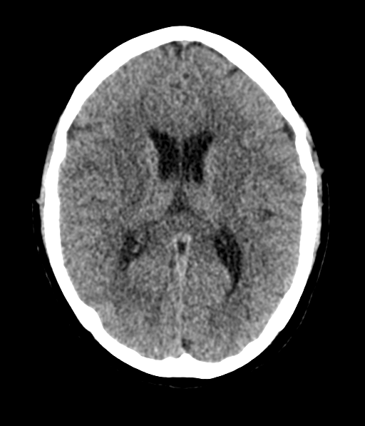 Cerebellar metastases - colorectal adenocarcinoma (Radiopaedia 40947-43652 Axial non-contrast 36).png