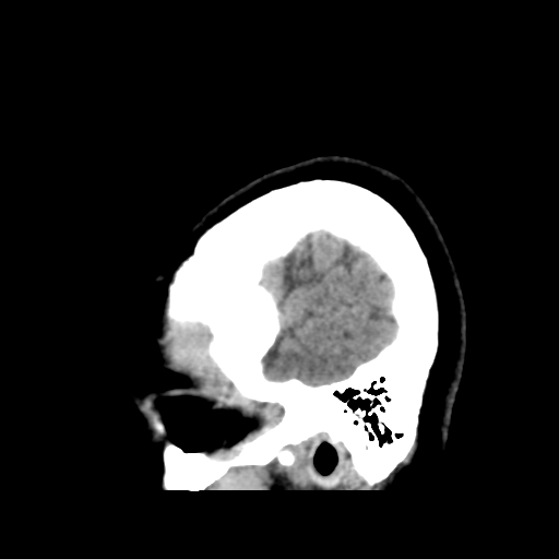Cerebellar metastasis (cystic appearance) (Radiopaedia 41395-44258 E 49).png