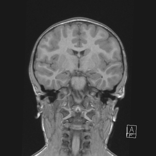 File:Cerebellar stroke (Radiopaedia 32202-33150 Coronal T1 30).png