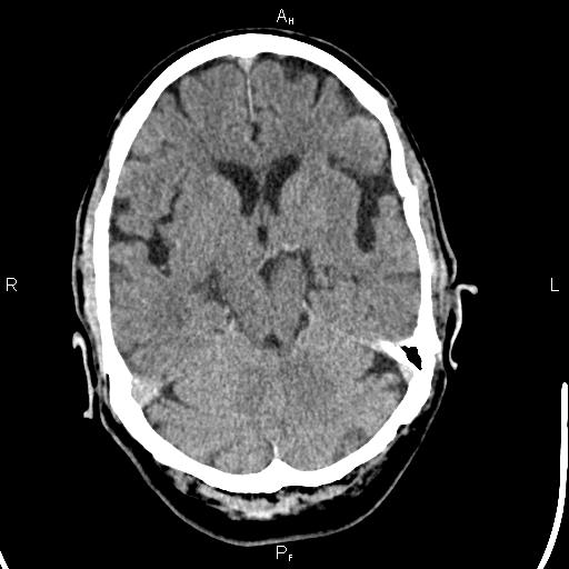 Cerebellopontine angle arachnoid cyst (Radiopaedia 85149-100704 Axial With contrast 18).jpg