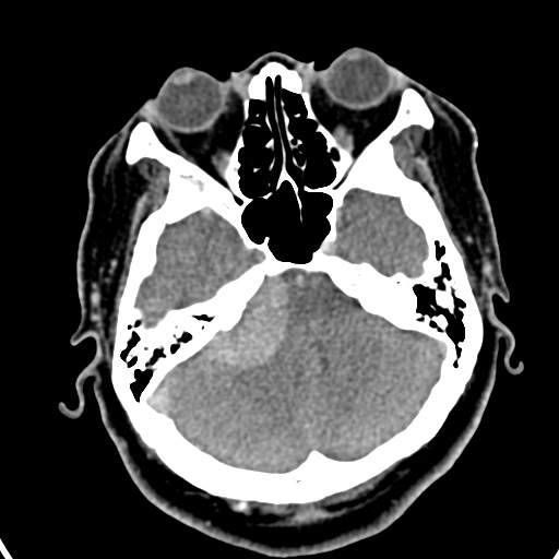 Cerebellopontine angle meningioma (Radiopaedia 35181-36714 A 25).jpg