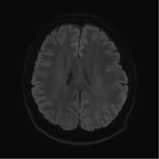 Cerebellopontine angle meningioma (Radiopaedia 48434-53348 Axial DWI 61).png