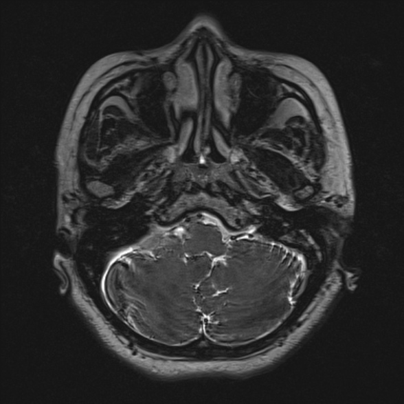 Cerebellopontine angle meningioma (Radiopaedia 53561-59591 Axial 3D volume T2 38).jpg