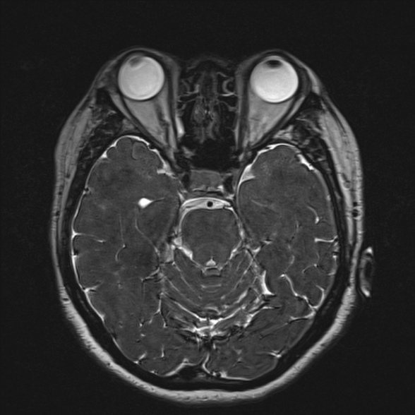 File:Cerebellopontine angle meningioma (Radiopaedia 53561-59591 Axial 3D volume T2 85).jpg