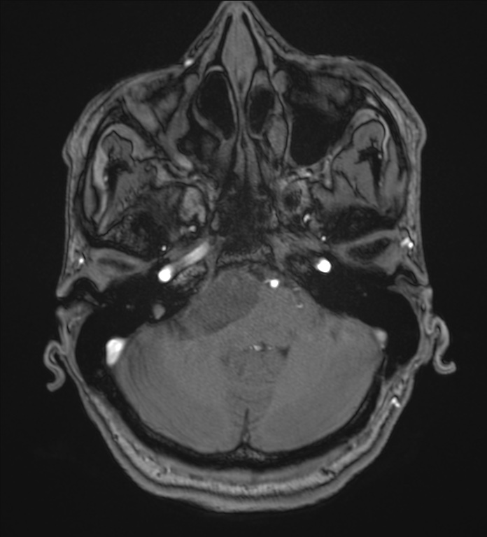Cerebellopontine angle meningioma (Radiopaedia 72983-83680 Axial MRA 20).jpg