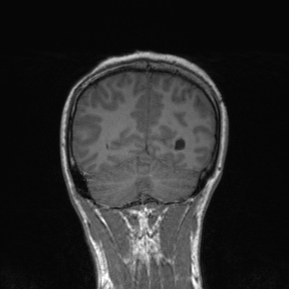 Cerebral abscess (Radiopaedia 24212-24478 Coronal T1 158).jpg