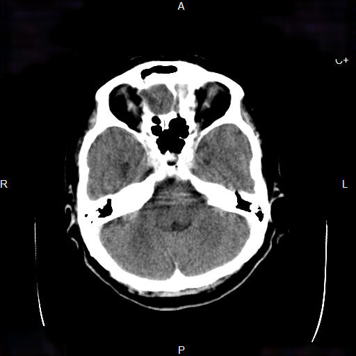 File:Cerebral abscess (Radiopaedia 7606-8432 Axial C+ delayed 3).jpg