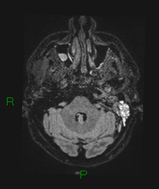 File:Cerebral abscess and subdural empyema (Radiopaedia 84436-99779 Axial FLAIR 65).jpg