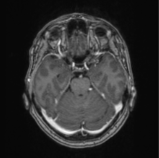 Cerebral abscess from pulmonary arteriovenous malformation (Radiopaedia 86275-102291 Axial T1 C+ 28).png