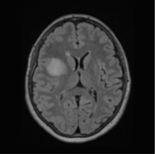 Cerebral abscess from pulmonary arteriovenous malformation (Radiopaedia 86275-102291 J 43).png
