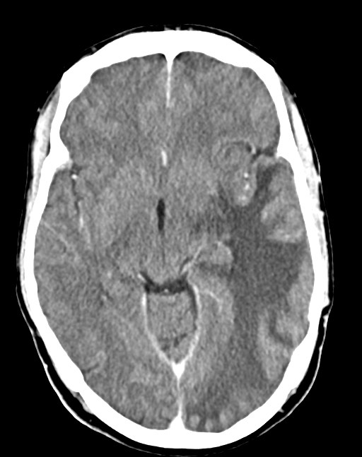 Cerebral abscesses (Radiopaedia 70458-80568 Axial Contrast 29).jpg