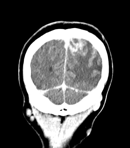 File:Cerebral abscesses (Radiopaedia 70458-80568 Coronal Contrast 58).jpg