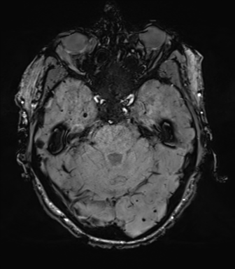 File:Cerebral amyloid angiopathy (Radiopaedia 46082-50433 Axial SWI 24).png