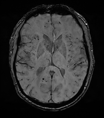 File:Cerebral amyloid angiopathy (Radiopaedia 46082-50433 Axial SWI 45).png