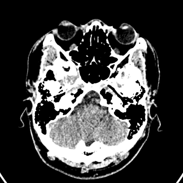 Cerebral arteriovenous malformation (Radiopaedia 37182-39012 Axial non-contrast 8).jpg
