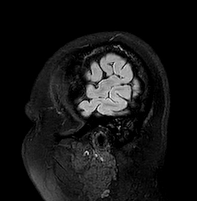 Cerebral arteriovenous malformation (Radiopaedia 74411-85746 Sagittal FLAIR 5).jpg