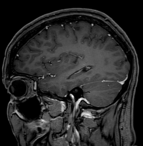 Cerebral arteriovenous malformation (Radiopaedia 74411-85746 Sagittal T1 C+ 32).jpg