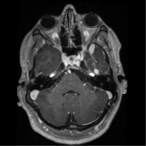 Cerebral arteriovenous malformation - huge (Radiopaedia 35734-37272 Axial T1 C+ 16).png