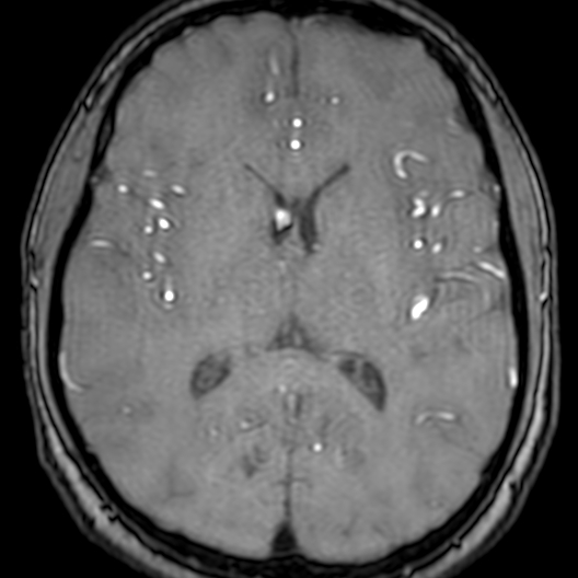 Cerebral arteriovenous malformation at posterior body of corpus callosum (Radiopaedia 74111-84925 Axial MRA 120).jpg